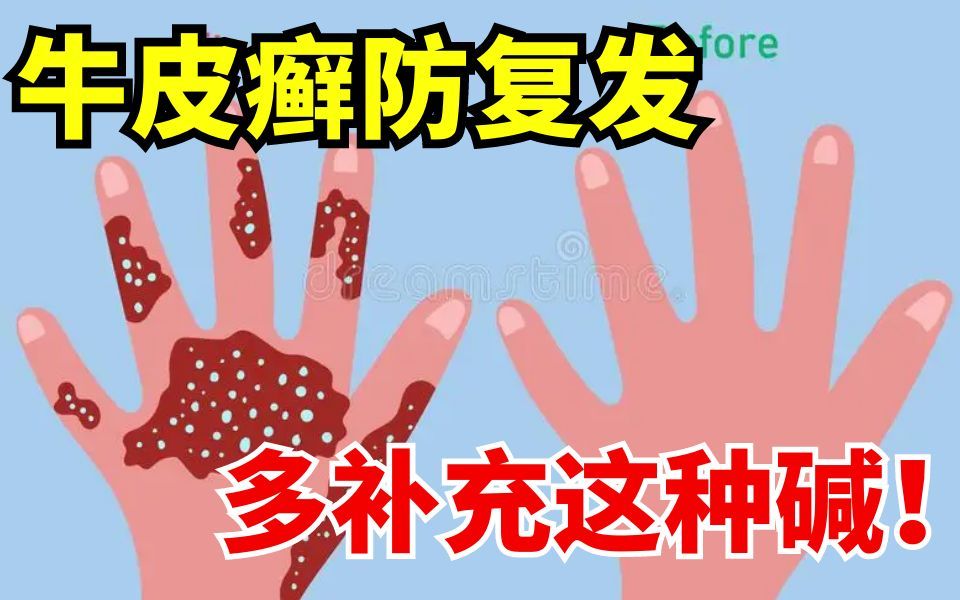 牛皮癣对抗复发秘诀:补好这种碱!哔哩哔哩bilibili