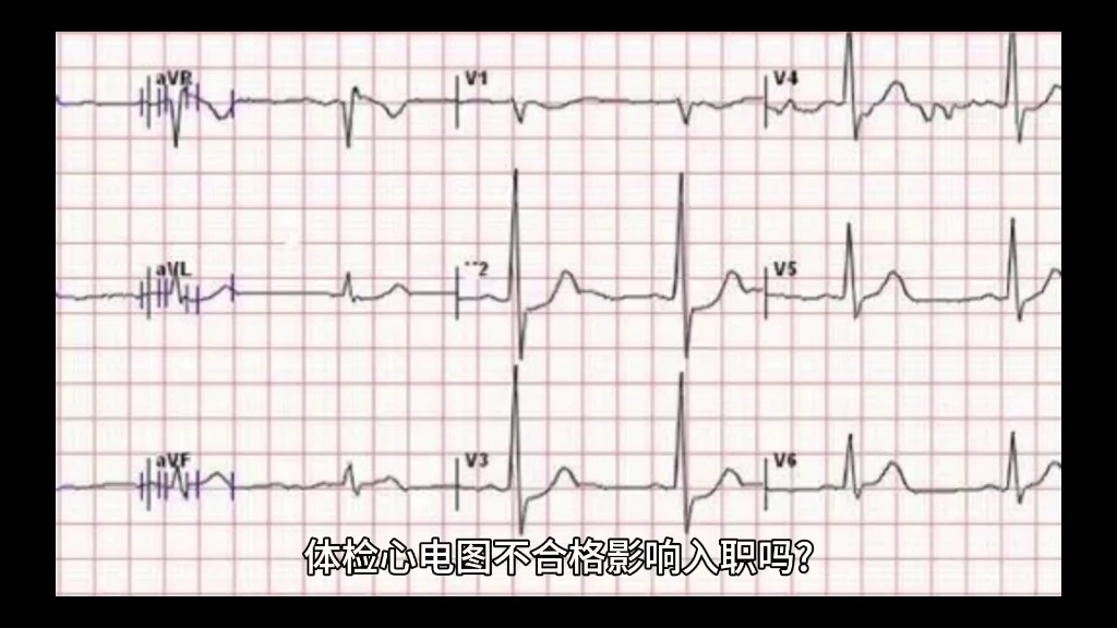 因为心电图被拒入职图片