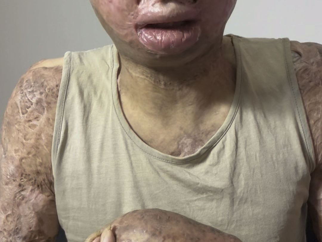 主页背景有我的帮助方式,身上疤痕拉扯导致生活不能自理,我也是没办法