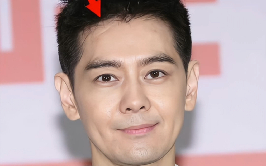 林志颖车祸后首露脸部伤疤 #林志颖 透露在车祸中受到撞击后,眼睛舷 