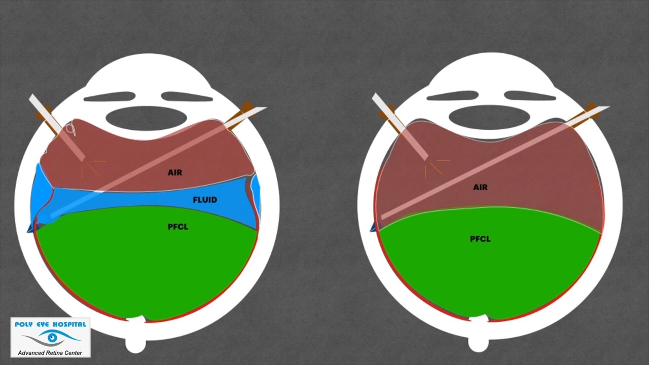 SIMPLIFYING FLUID AIR EXCHANGE  玻璃体视网膜手术:气液交换术技巧哔哩哔哩bilibili