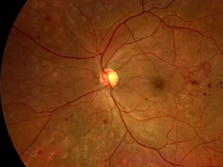 neuroretinopathy图片