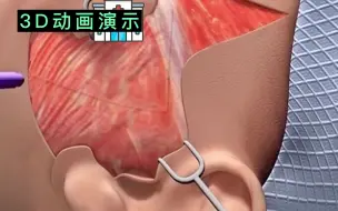 Download Video: 30秒看懂拉皮，看完你还敢做吗？