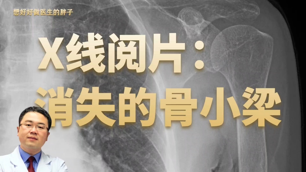 老人肩痛检查X线,医生阅片后觉得惊讶,老人的骨小梁消失了!哔哩哔哩bilibili