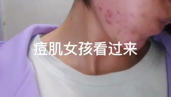 痘痘肌女孩看过来