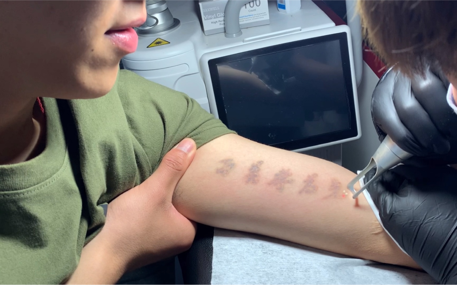 当兵洗纹身真实记录,纹身一定要谨慎!