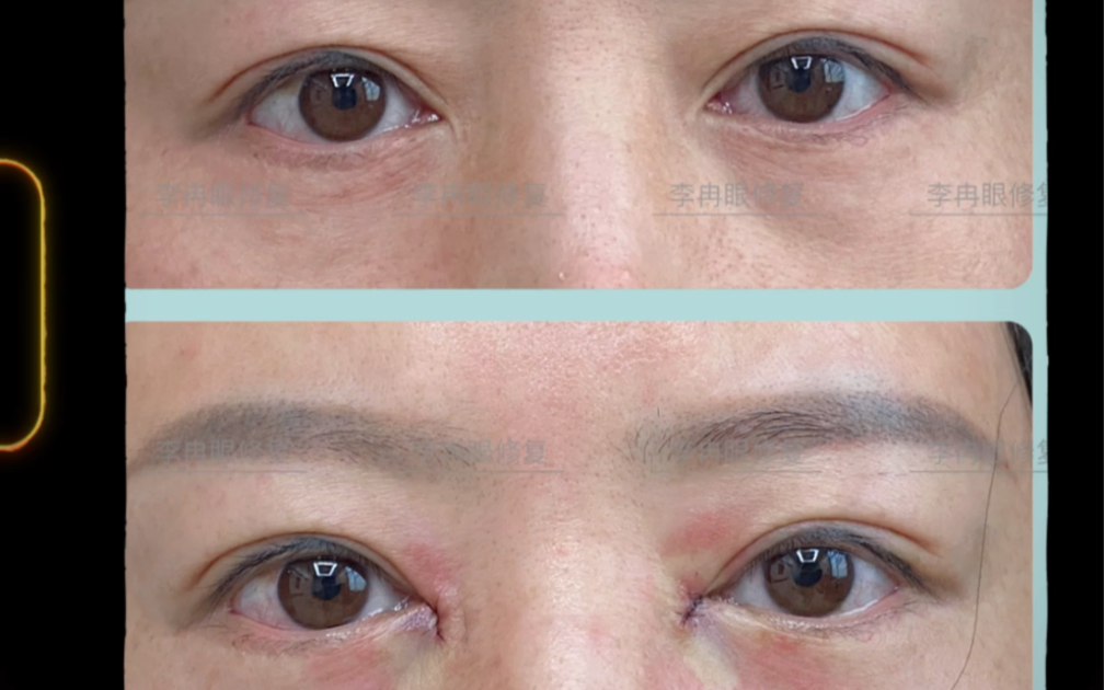 李冉包眼角——内眼角修复回包案例赏析