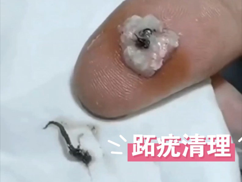跖疣连根往外拔,好多黑色丝状物