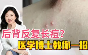 Descargar video: 你的后背有没有长过这些痘痘？这是细菌性毛囊炎引起的！