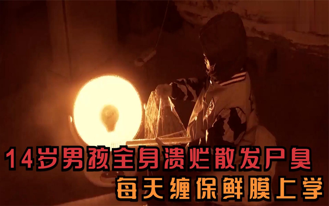 14岁男孩怪病缠身,全身溃烂散发尸臭,每天缠保鲜膜上学!纪录片