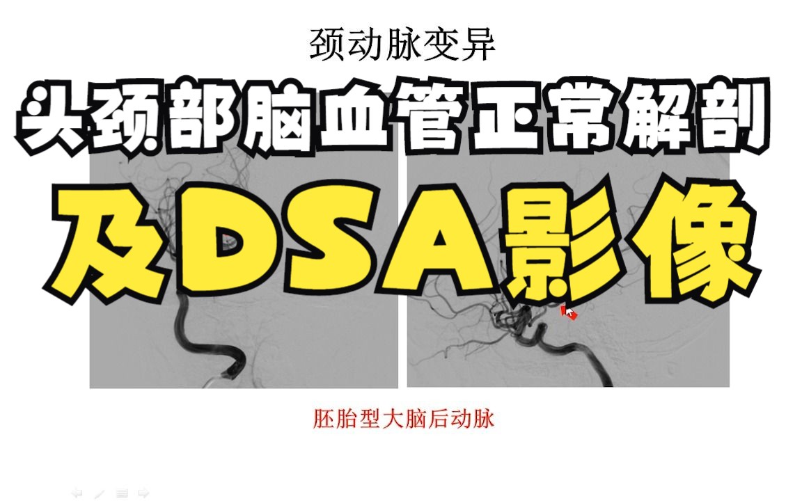 [图]头颈部脑血管正常解剖及DSA影像