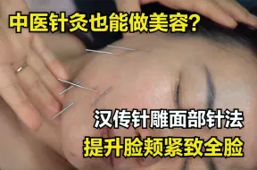 Tải video: 中医针灸也能做美容？分享汉传针雕面部针法，提升脸颊紧致全脸！王瑞雪汉传针雕！