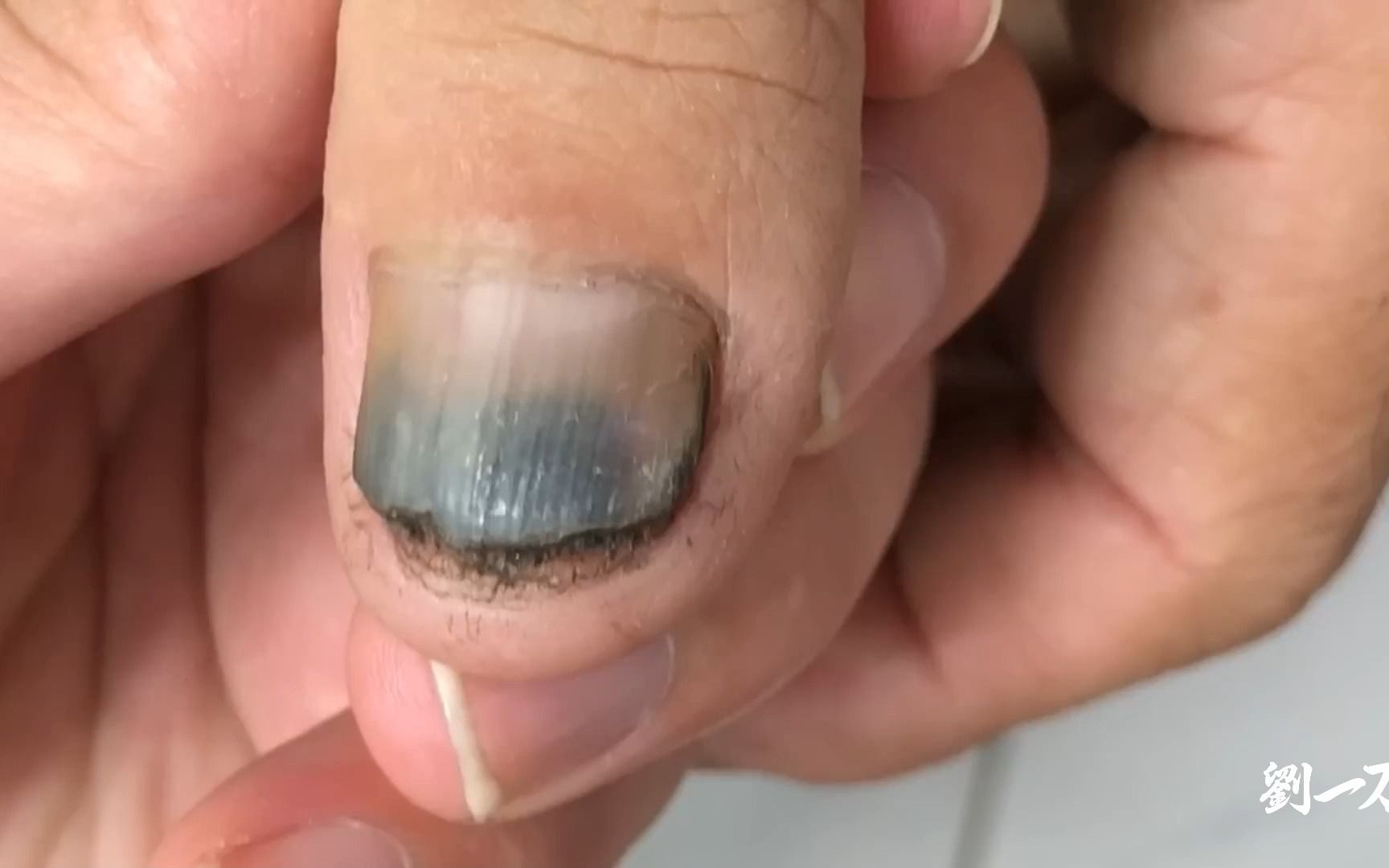 【劉一刀修脚】【甲沟炎】这都不是灰指甲了是黑指甲