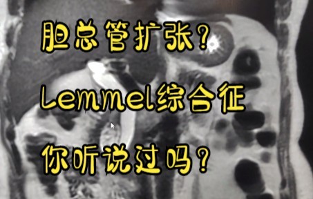 胆总管扩张的少见原因Lemmel综合征、十二指肠憩室梗阻性黄疸综合征哔哩哔哩bilibili