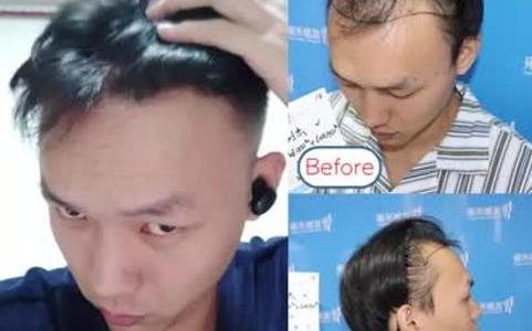 [图]植髮真的有用嗎？術後髮友心得分享Yonghe hair transplant