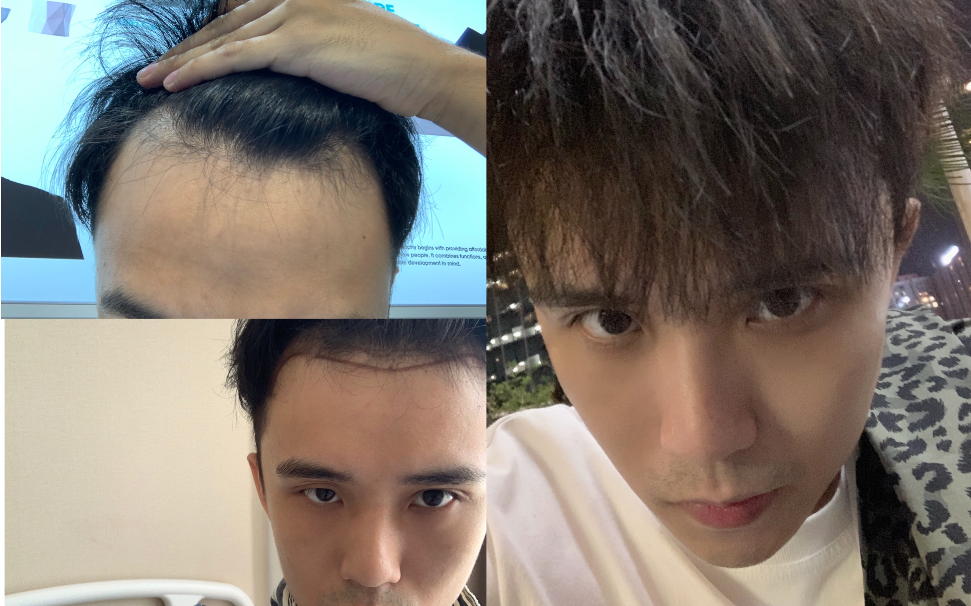 帅小伙脱发植发两年后分享植发过程经历