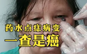 Tải video: 阿姨自己买药水点痣，越点越大，一查竟是癌