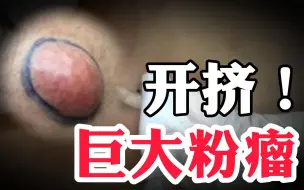 Tải video: 【三甲医生】下饭视频来了，挤超巨大粉瘤谁看？