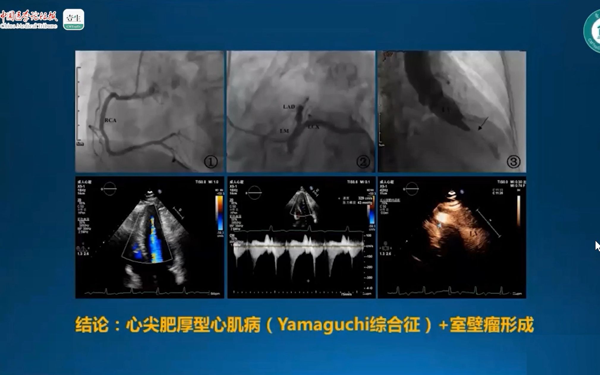 【零基础、手把手教你学心脏超声系列】8. 如何解读肥厚型心肌病超声报告哔哩哔哩bilibili