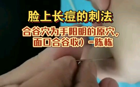 脸上长痘的刺法(合谷穴为手阳明的原穴,面口合谷收)陈栋哔哩哔哩bilibili