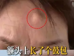额头长了鼓包怎么处理？