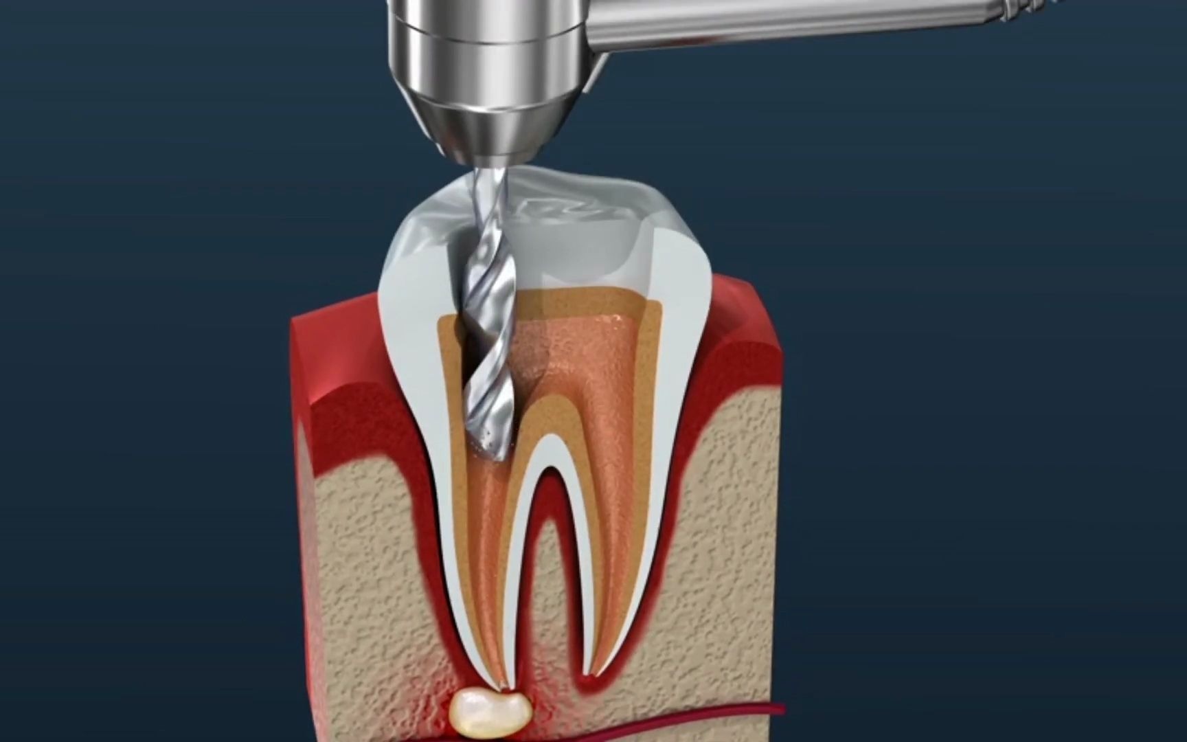根管治疗动画演示 你的牙神经就是这么被抽出来的