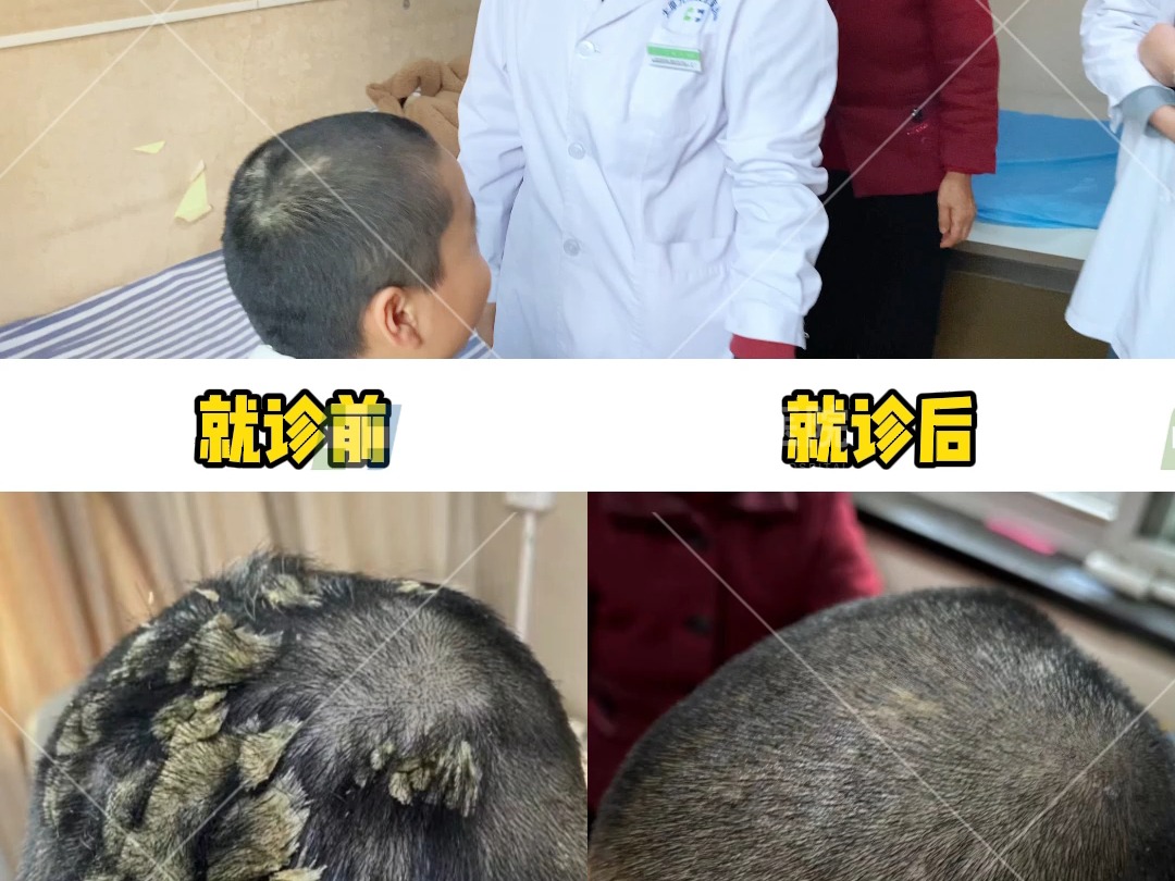 儿童头部银屑病就诊前后对比 山西太原九州银屑病医院哔哩哔哩bilibili