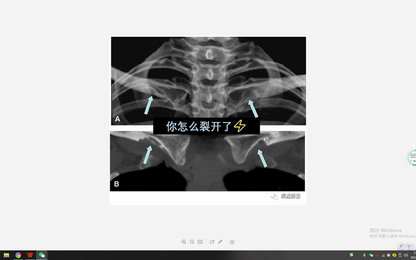 锁骨常见变异——菱形窝哔哩哔哩bilibili