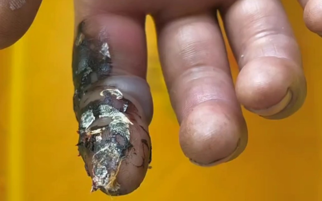 五步蛇咬到食指,都发黑了还不去医院打血清,华佗在世也救不了!