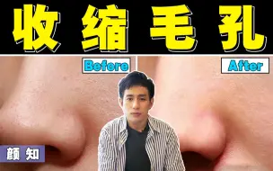 Download Video: 【医学博士】如何拯救草莓鼻？I 毛孔粗大还有救吗？