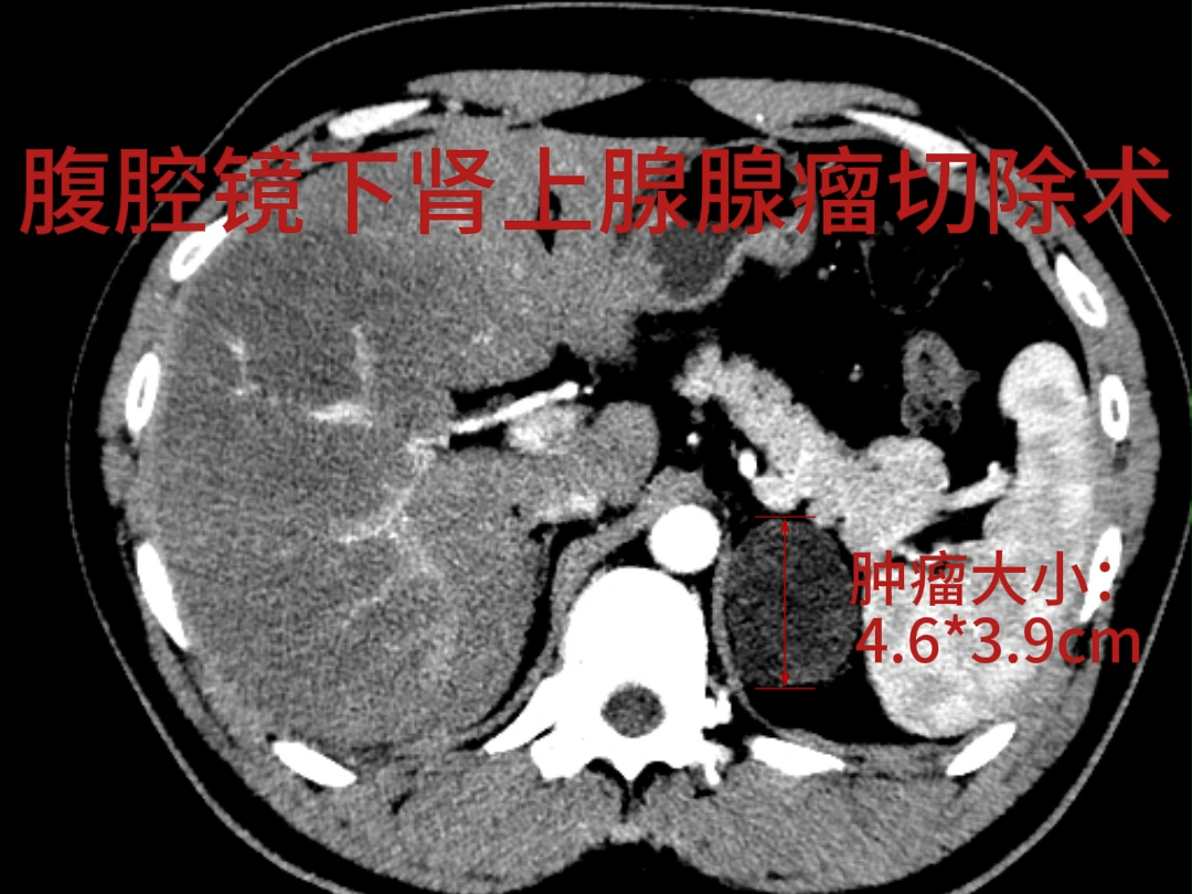 泌尿外科——腹腔镜下肾上腺瘤切除术哔哩哔哩bilibili