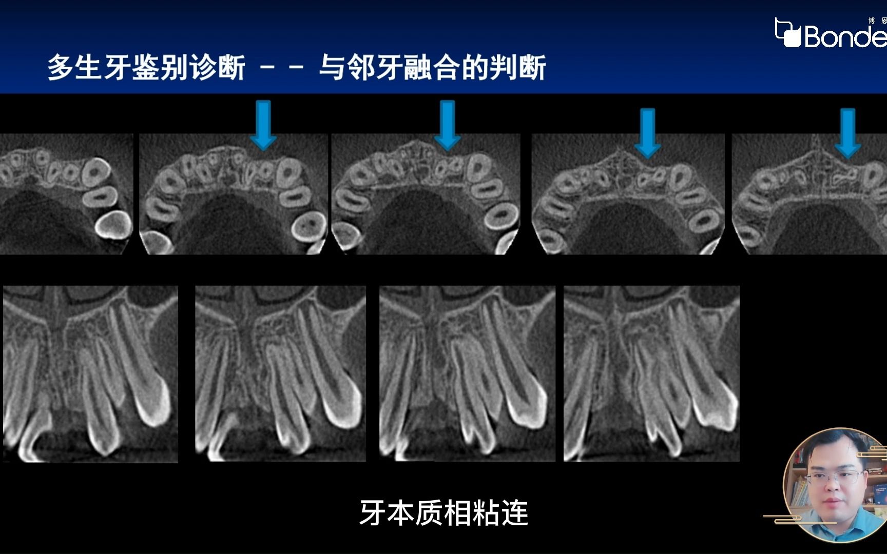 31多生牙影像学诊断中的注意事项哔哩哔哩bilibili