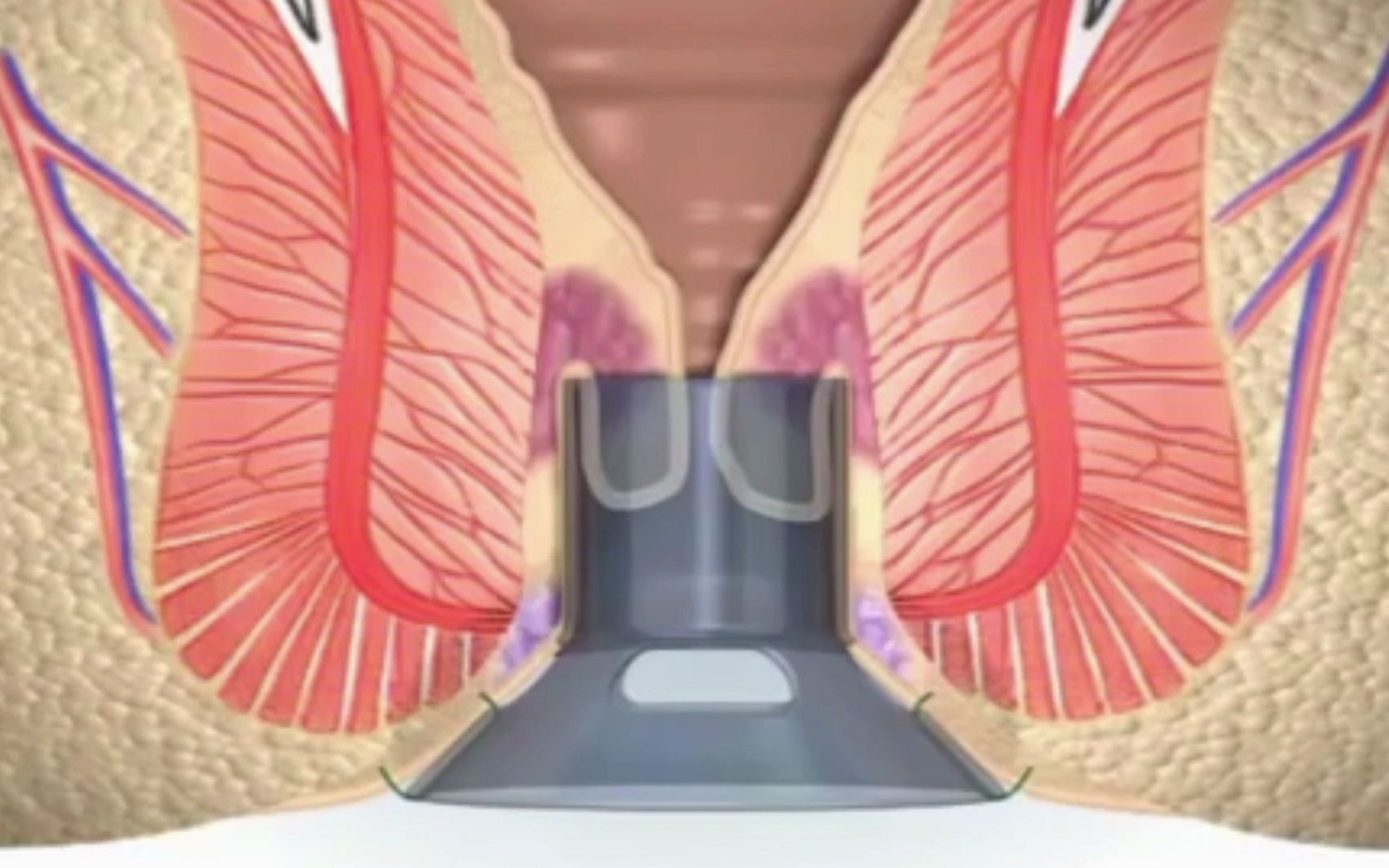 [图]3D动画视频：痔疮手术，疼痛溢出屏幕！