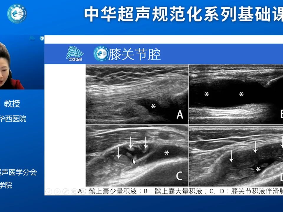 [图]肌骨超声精讲第11课-膝关节常见疾病及超声诊断