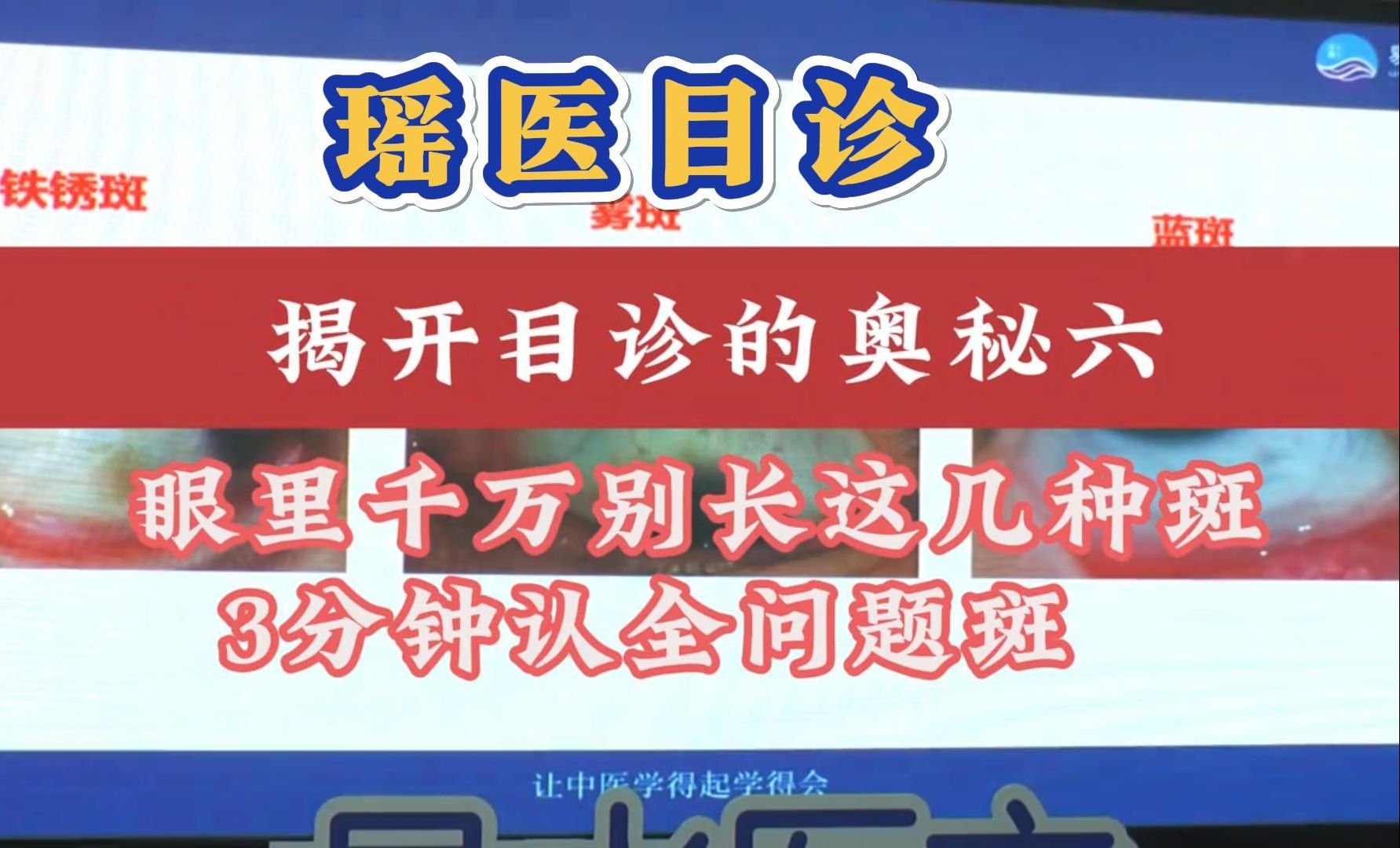 瑶医目诊:带你揭开目诊的奥秘,眼里的这几种斑块!问题很大!吕丽五维综合望诊哔哩哔哩bilibili