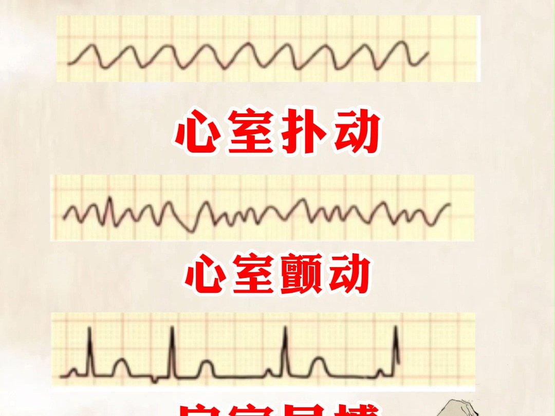 室颤与室扑心电图特点图片