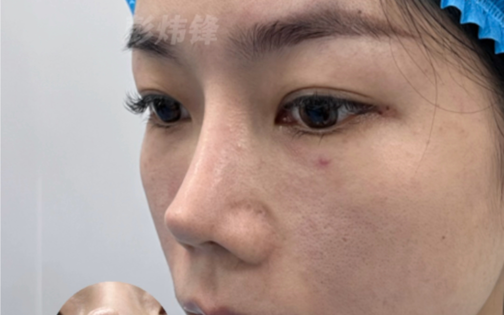 鼻子又翘又尖,想要自然圆润点的鼻子
