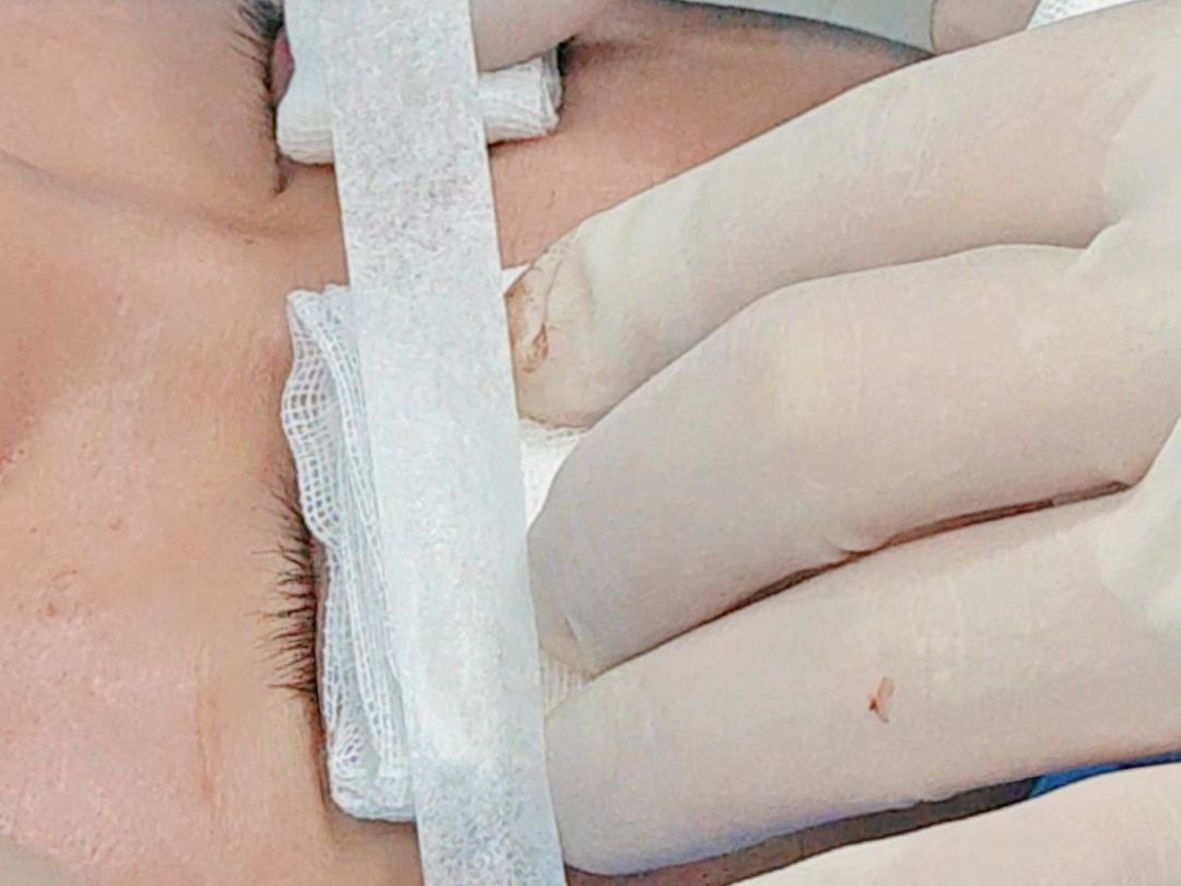 双眼皮术后包了纱布,看的到路吗?