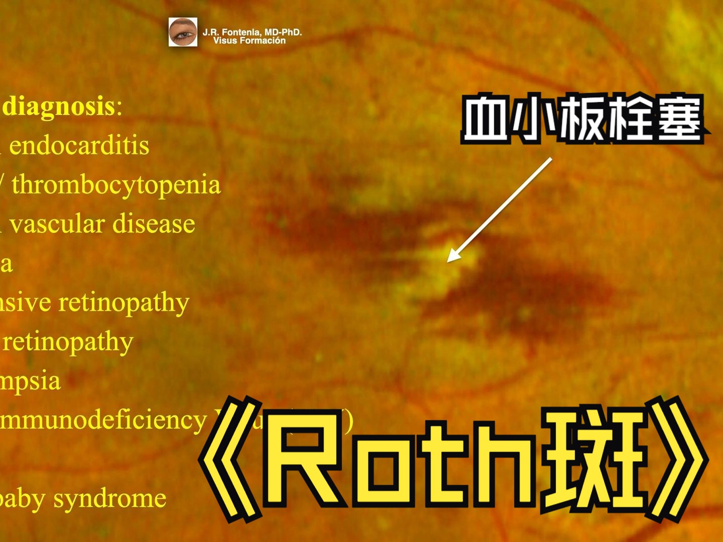 【中英双字】【中心白点视网膜出血:Roth斑】Roth Spots哔哩哔哩bilibili