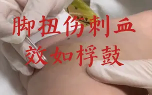 下载视频: 脚扭伤刺血，疼痛立刻缓解！