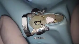 Download Video: 乳牙根管治疗的实操讲解