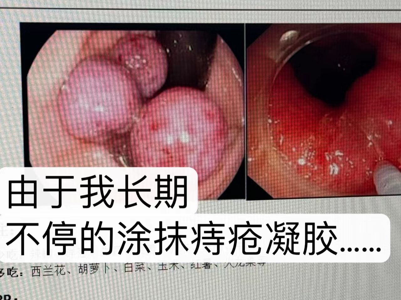 痔疮干瘪照片图片