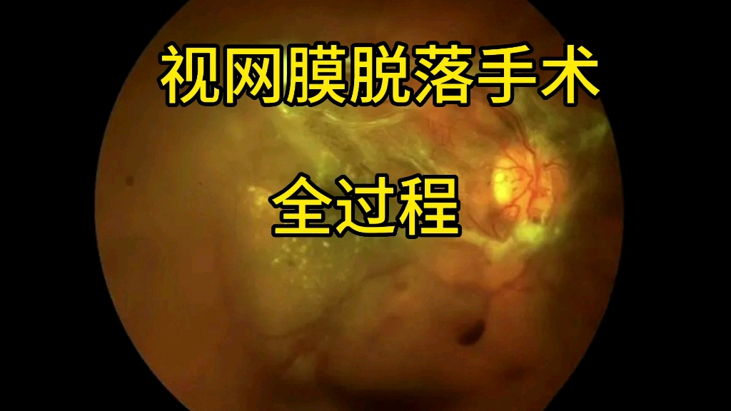 个人经历视网膜脱落手术全过程