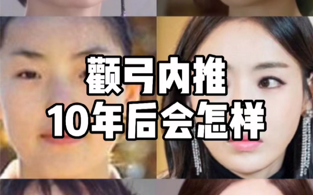 【整商】颧弓内推10年后会怎样哔哩哔哩bilibili