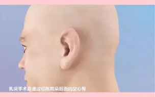 Скачать видео: 3D视频演示：乳突根治术全过程