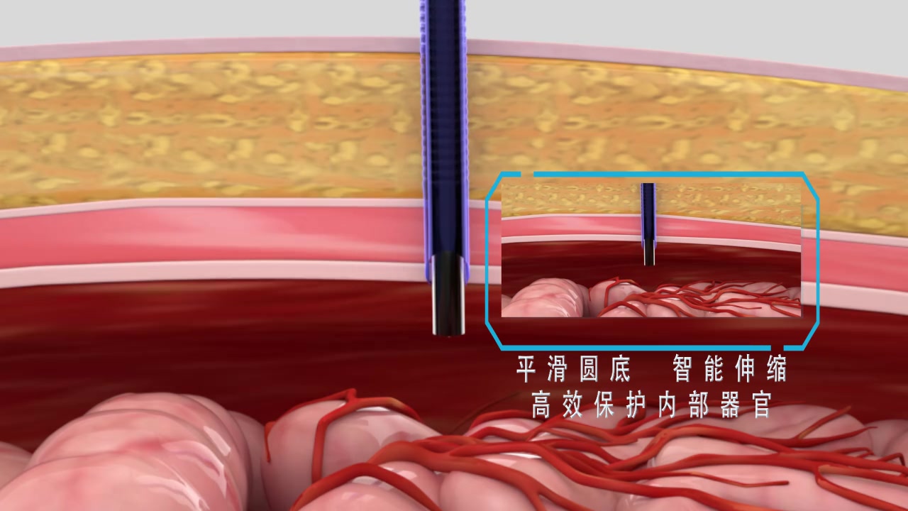 一次性使用腹部穿刺器产品视频哔哩哔哩bilibili