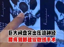 Download Video: 巨大间盘突出压迫神经腰疼到脚建议微创手术