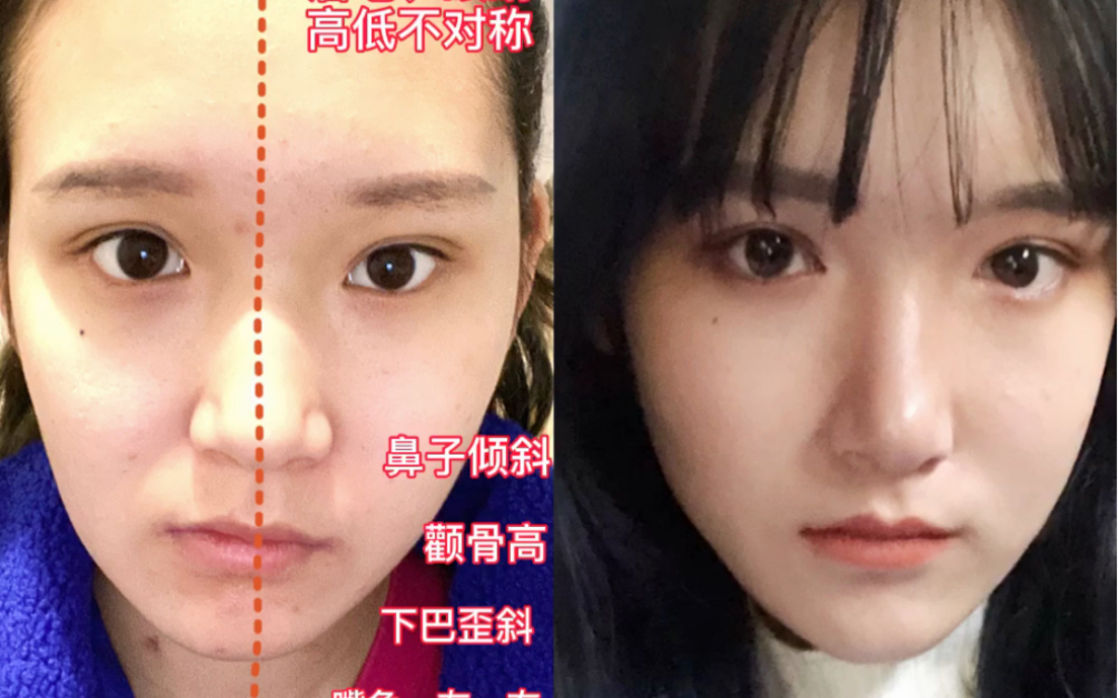 科学矫正下颌歪斜|大小脸元凶 get上镜脸_哔哩哔哩_bilibili