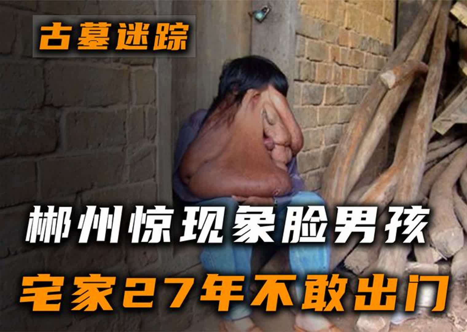 郴州惊现象脸男孩，宅家27年不敢出门，医生看到惊呼：前所未闻