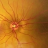【油管搬运】散瞳眼底检查|Animation Dilated Eye Exam